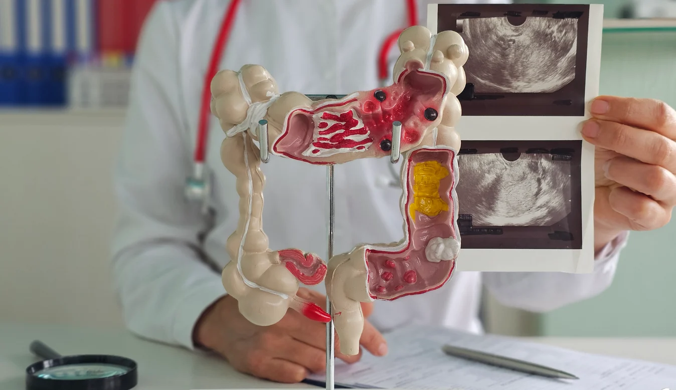 Colonoscopy: What to Expect Before, During and After
